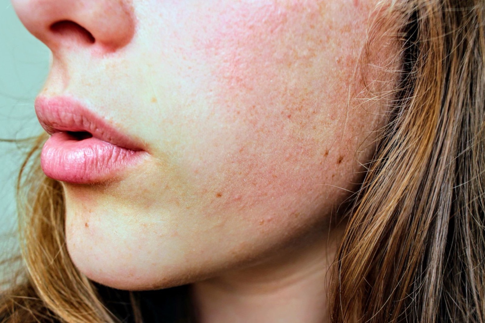 Rosacea (chứng đỏ mặt): biểu hiện, yếu tố khởi phát, chăm sóc da